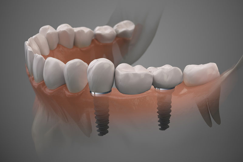 Discover the Future of Dental Care: Dental Implants in Phoenix, AZ